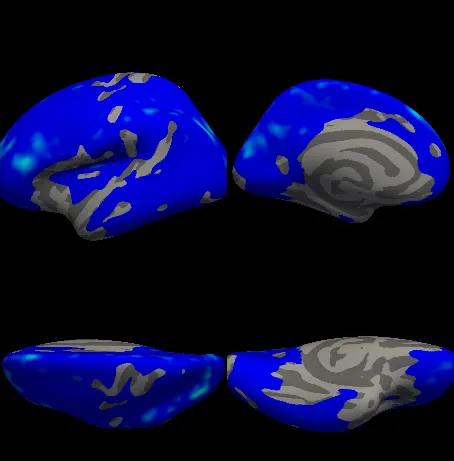 Four views of the left hemisphere: the age t-statistic in blue over most of the cortex